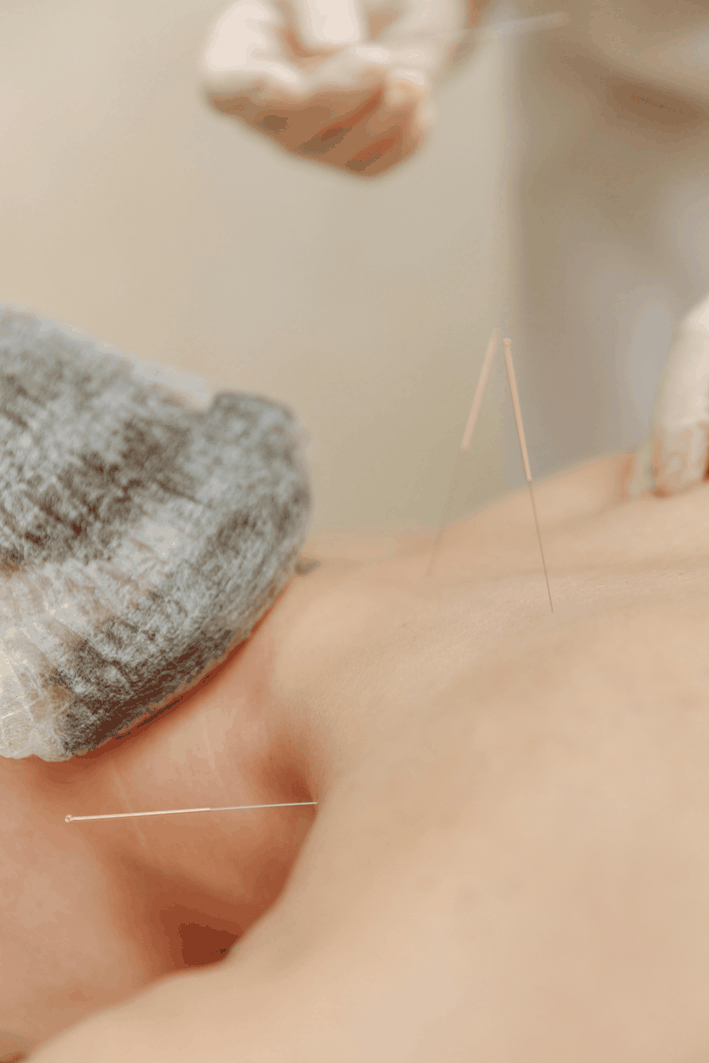 Acupuncture